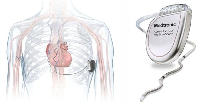 Aurora EV-ICD System